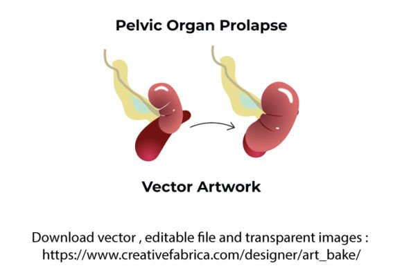 Pelvic Organ Prolapse Vector: Medical Graphics & Icons